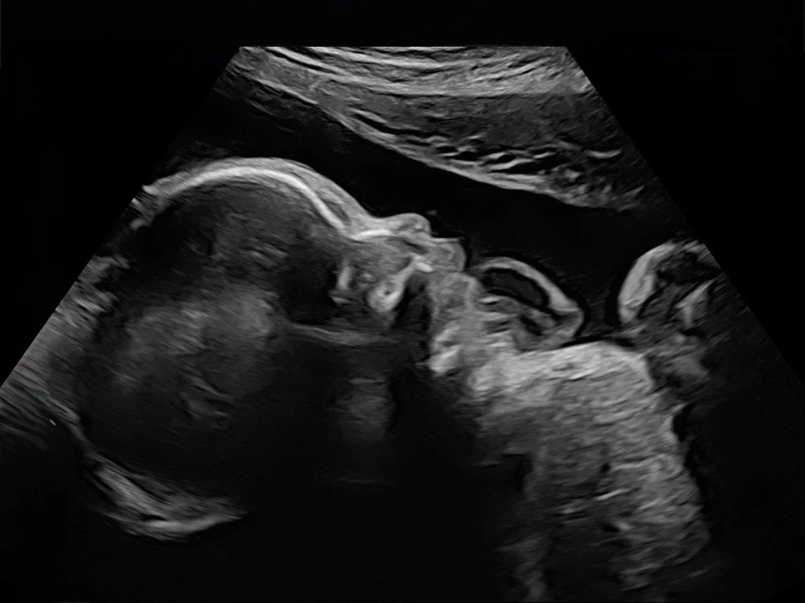 2D pregnancy ultrasound image of a developing baby at Baby Bliss Ultrasound in Houston, TX