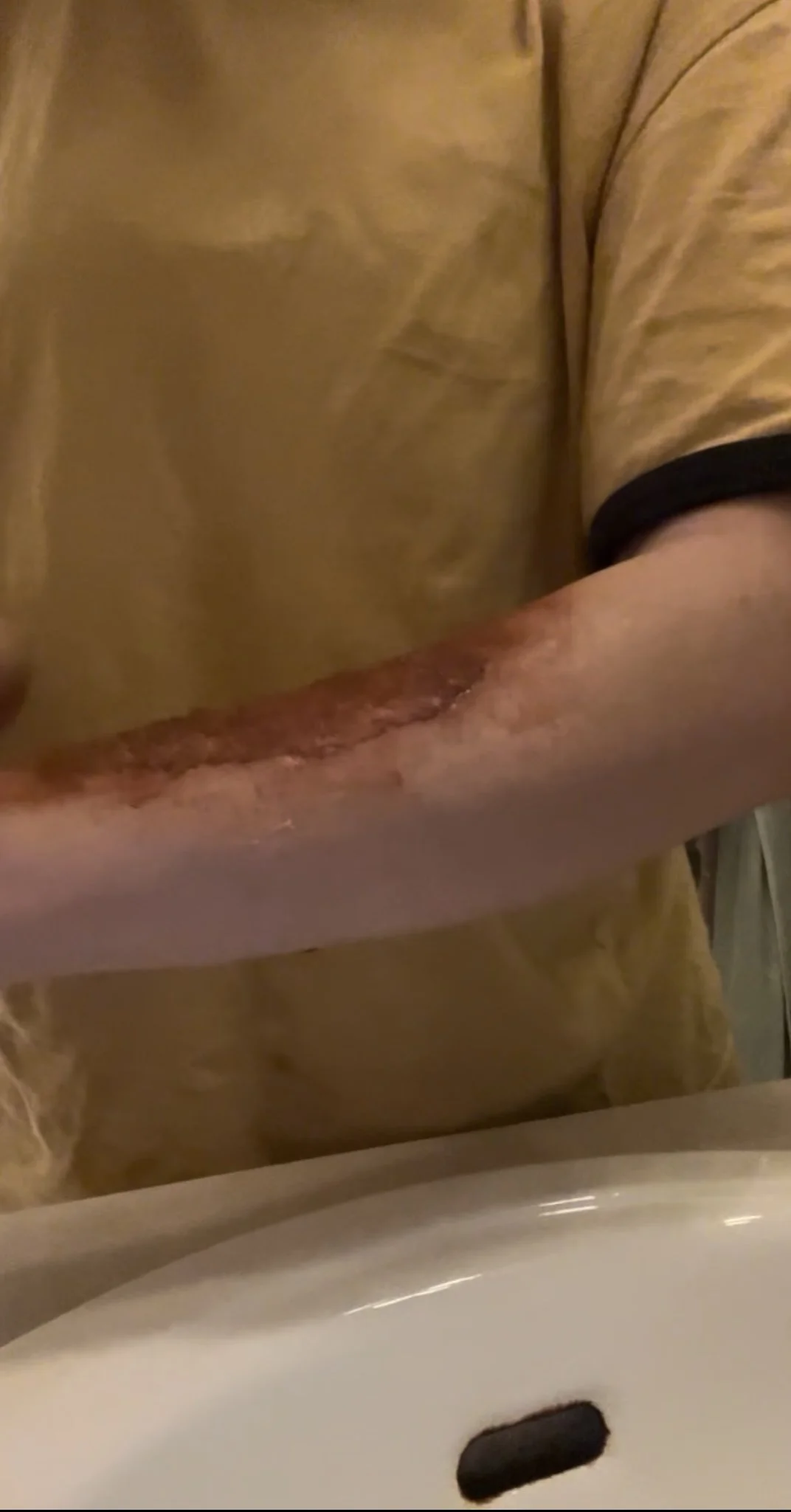 2nd-3rd degree burn achieved with liquid latex, cotton balls, and eyeshadow.