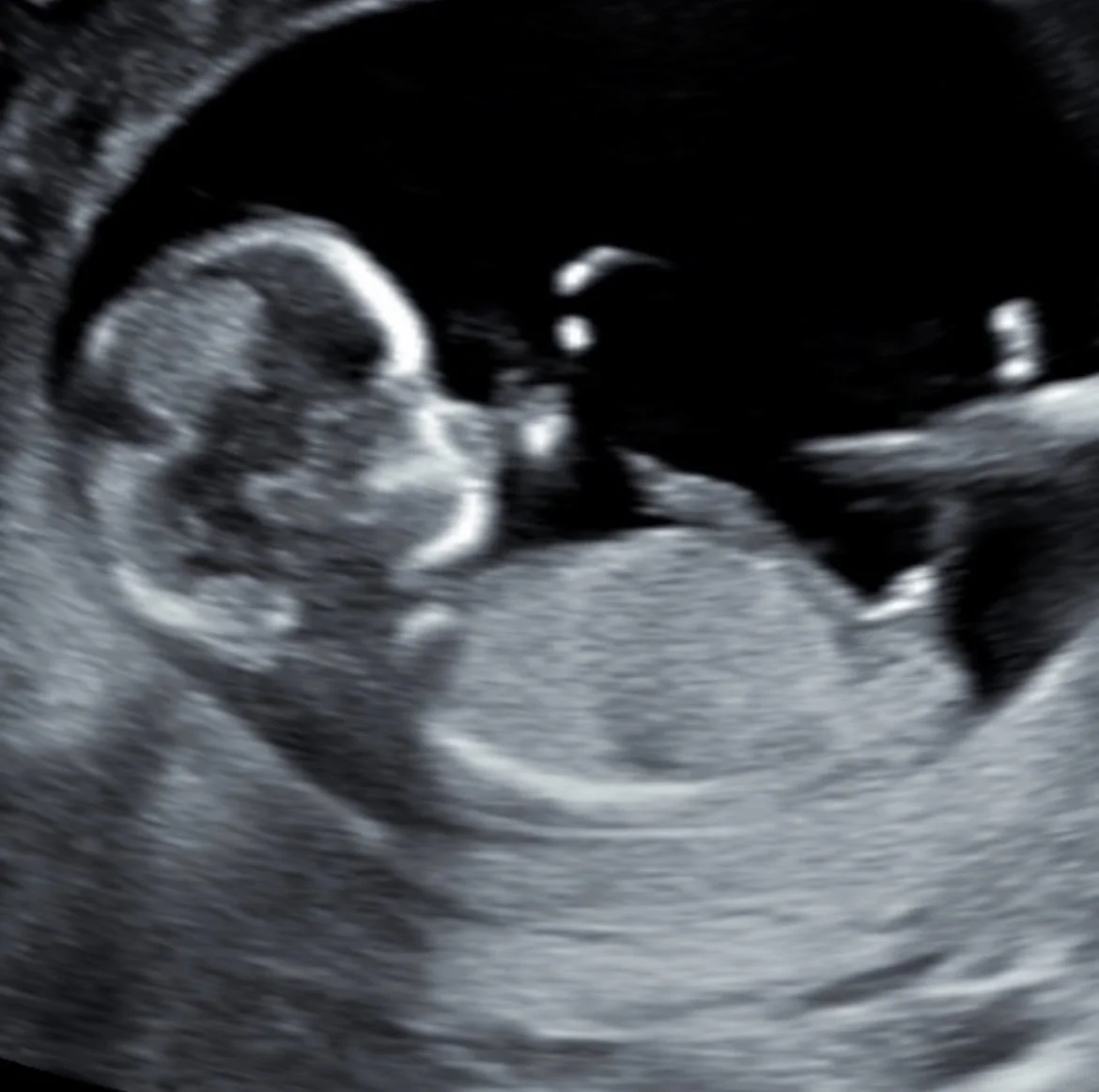 11 weeks pregnant in 2D