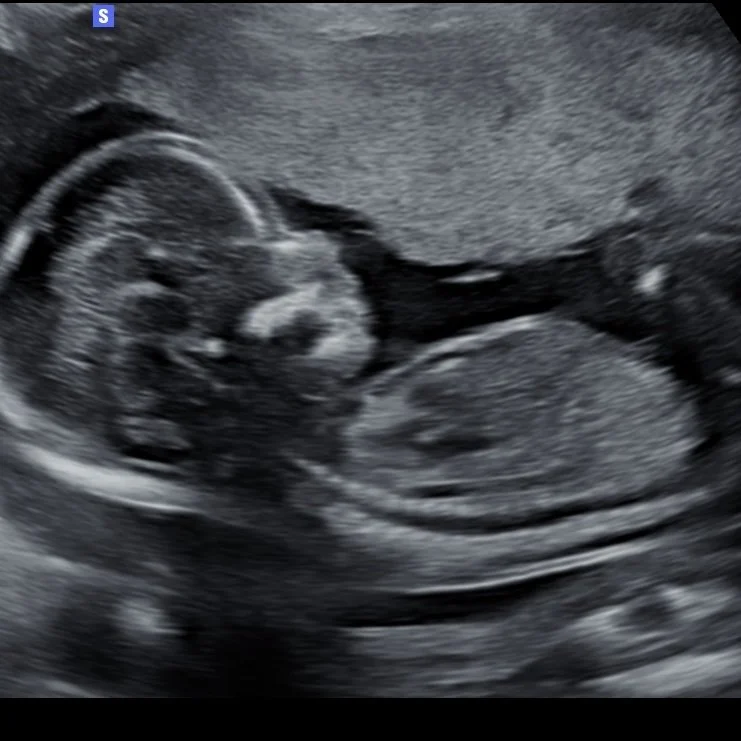 Ultrasound image of a developing fetus inside the womb