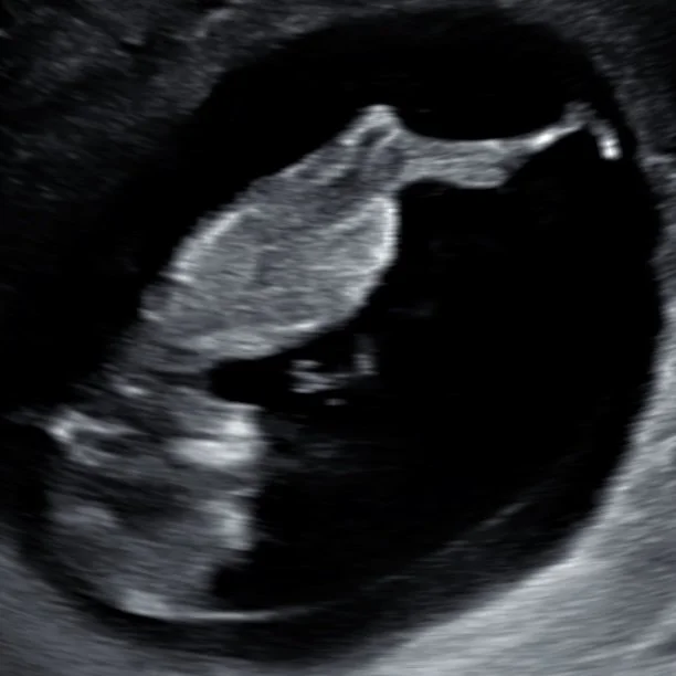 Ultrasound image of a developing fetus inside the womb.