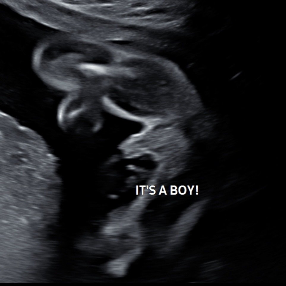 Ultrasound image of a fetus with the text "IT'S A BOY!" gender reveal