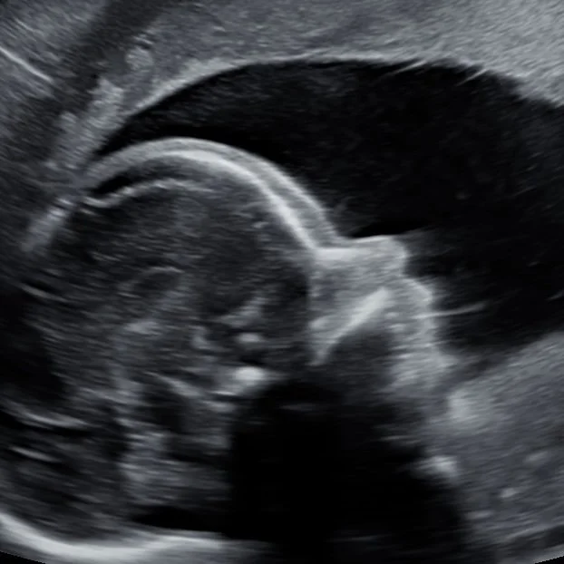 Side profile of baby ultrasound