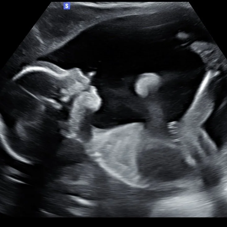 Ultrasound image of a developing fetus inside the womb.