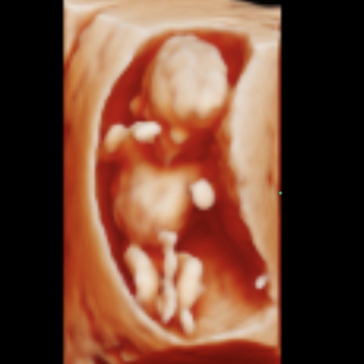 A 3D ultrasound image of a developing fetus inside the mother's womb.