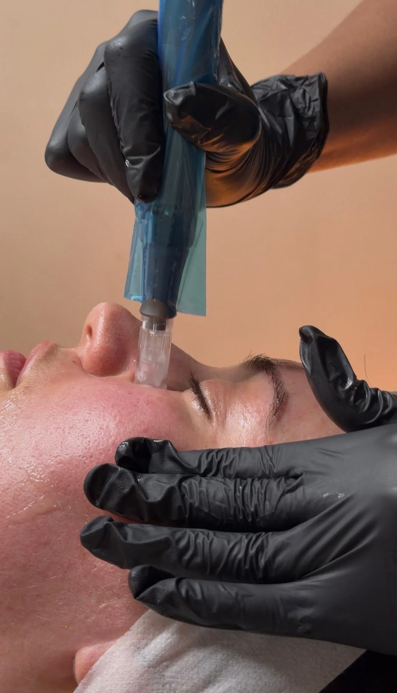 microneedgling with salmon dna at hk hammam spa 