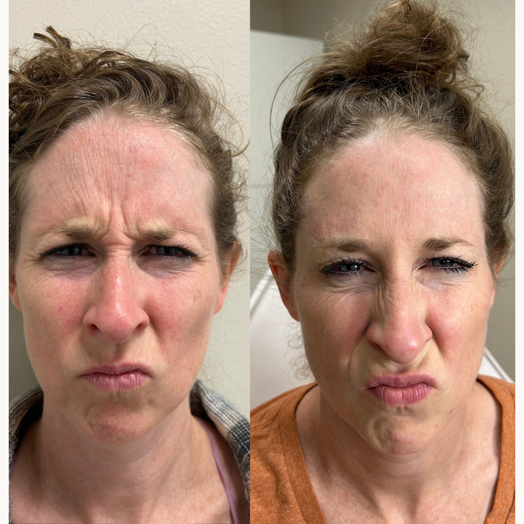 Glabellar Lines (11s)