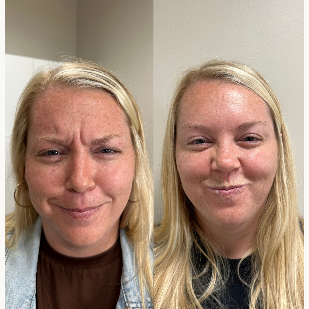 Glabellar Lines (11s)