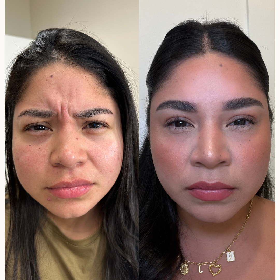 Glabellar Lines (11s)