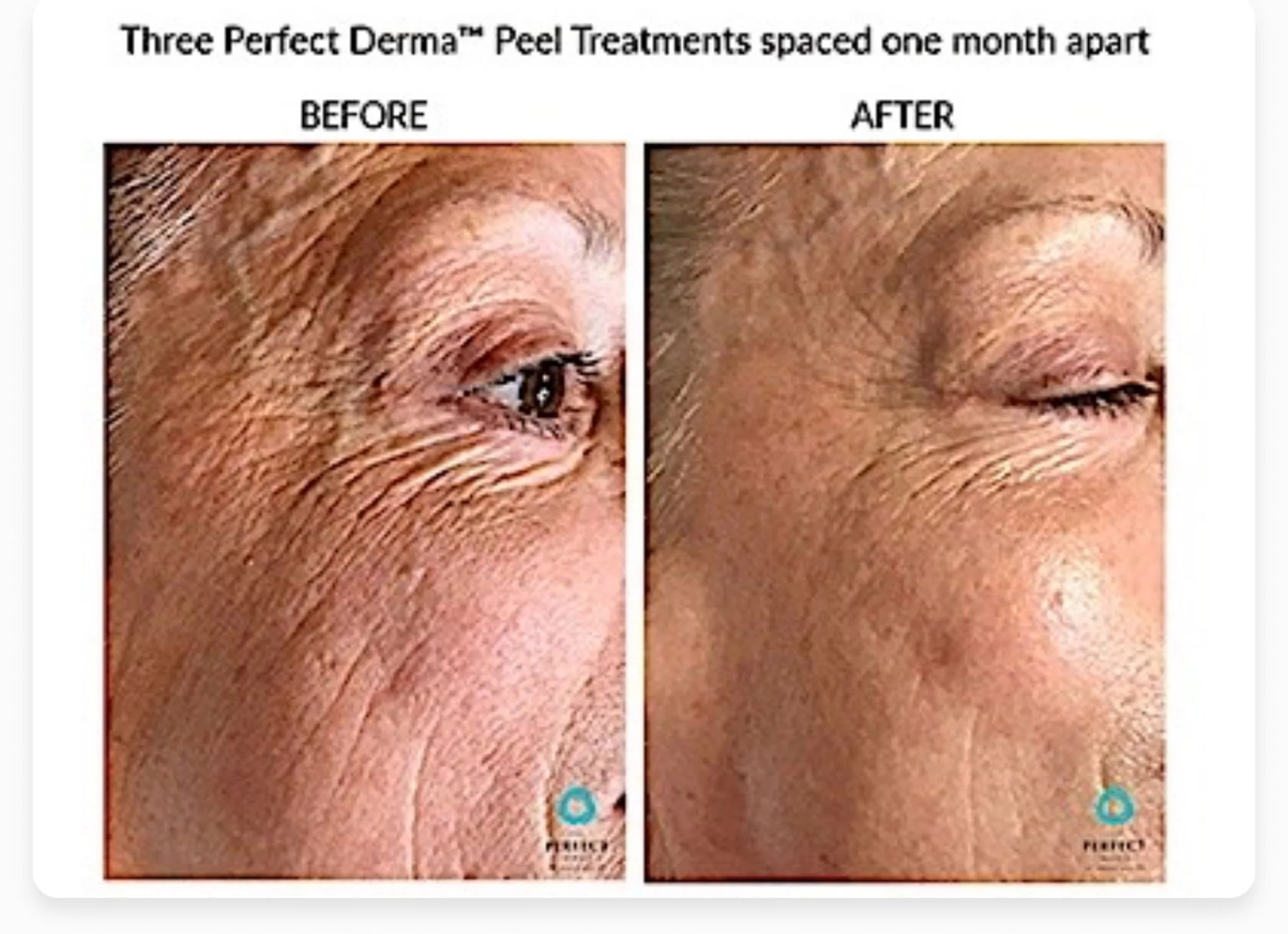 Side-by-side comparison of facial skin before and after using Three Perfect Derma Peel Treatments, showing reduction of wrinkles and improved skin texture.