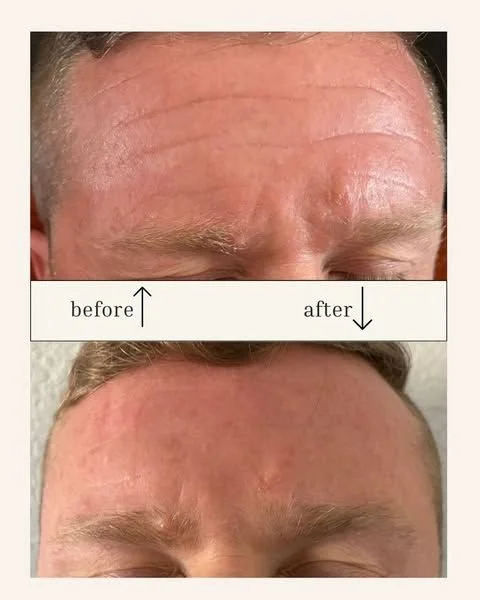 Comparison of a man's forehead showing wrinkles before and after treatment, with the 'before' image displaying more wrinkles and the 'after' image showing a smoother forehead.