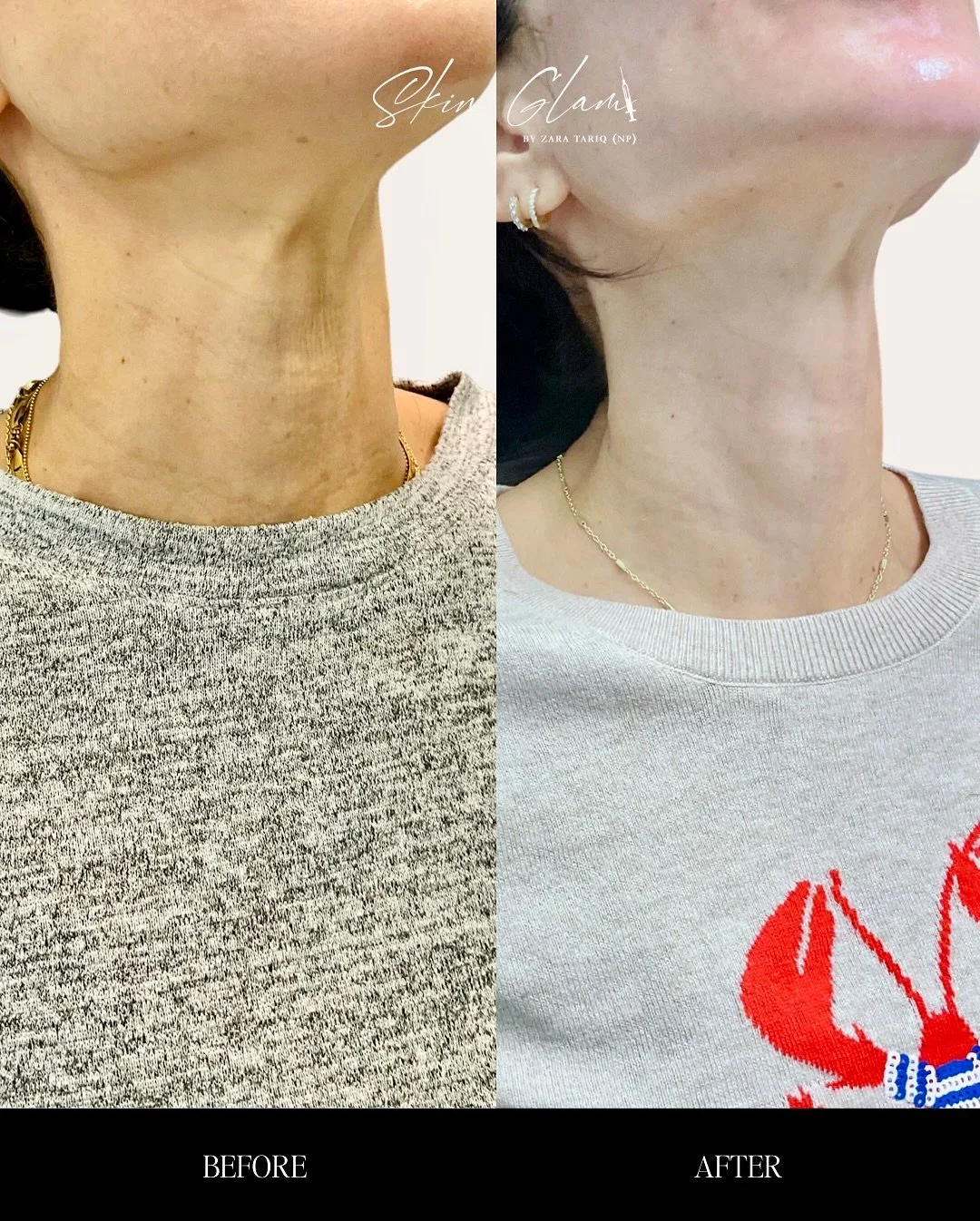 ✨ PSA: Don&rsquo;t forget your neck ✨
We baby our faces, but your neck deserves just as much love 🤍
This glow is from a combo of:
💉 HD Radiesse gold protocol (hello collagen boost)
💉 Platysmal band tox for that snatched look
🧴 A luxe neck cream t