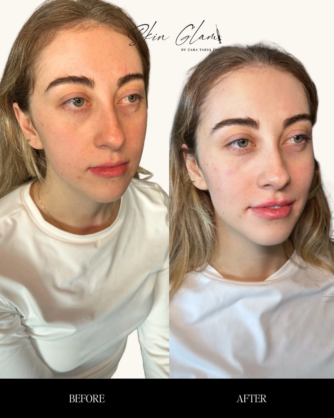 Yesterday&rsquo;s @evolus training was such an inspiring day 💉✨ Huge thank you to my beautiful model, one of my very first clients here in Houston and an RN herself, for trusting me with some much-deserved self care before her birthday 🥰 The goal w