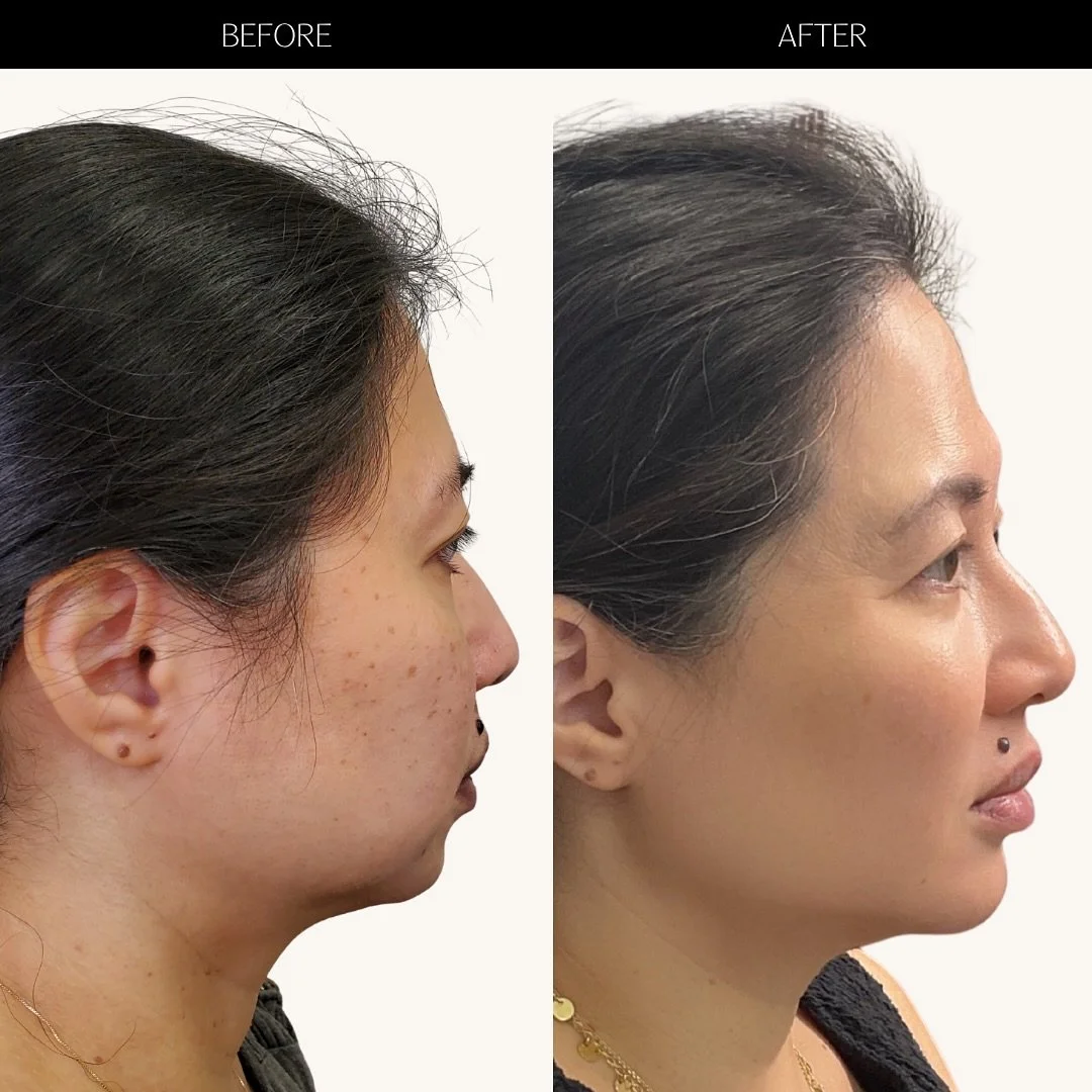 ✨3 years apart. Balanced, defined, and aging gracefully✨

This transformation reflects a holistic approach over time, not a single session.

You&rsquo;ll notice softer shadows and more balanced facial proportions, the result of gradual collagen resto