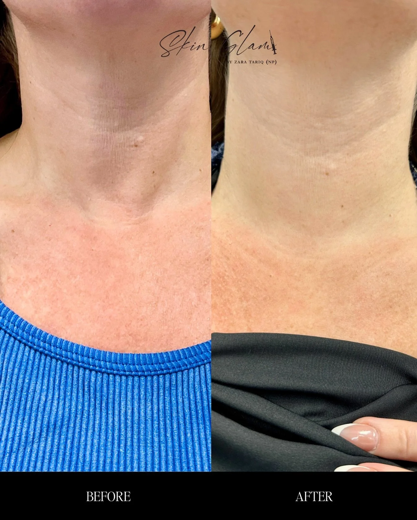 No filters, no hiding. ✨ Hyperdilute Radiesse is that girl for your neck. Want in? Slide into my DMs to book. #NeckRejuvenation #HyperdiluteMagic #ConfidenceBoost #skinglamglow