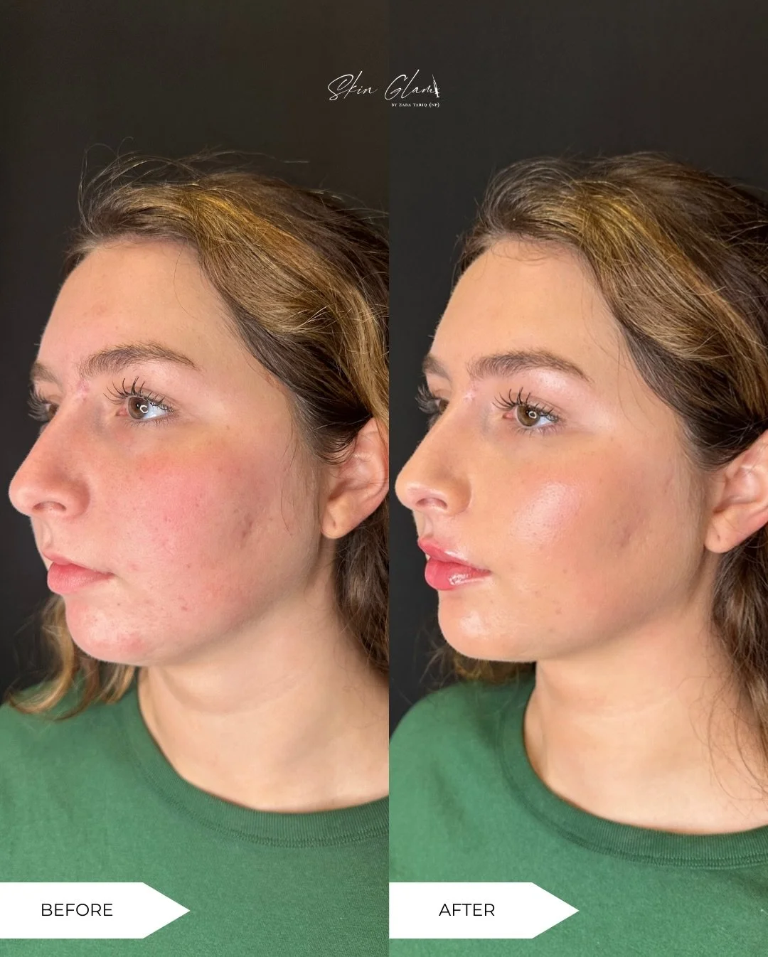 Injector thoughts: I could balance this so beautifully&hellip;
Client thoughts: &ldquo;Can we talk about my chin?&rdquo;

✨ Perfect timing ✨

Chin support + chin shadow correction + soft lip filler
Facial balancing on this gorgeous young face 🤍
A li