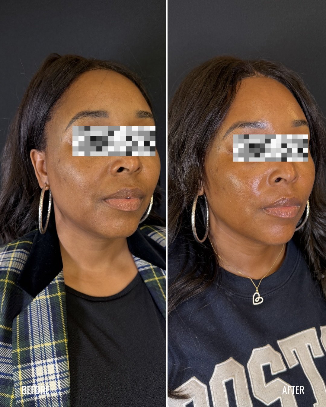 For the mom who has spent the last few years pouring into everyone else&hellip; sometimes a little self care is how you start finding yourself again. 🤍

This beautiful mama trusted me with a full face of Daxxify and subtle lower face balancing fille