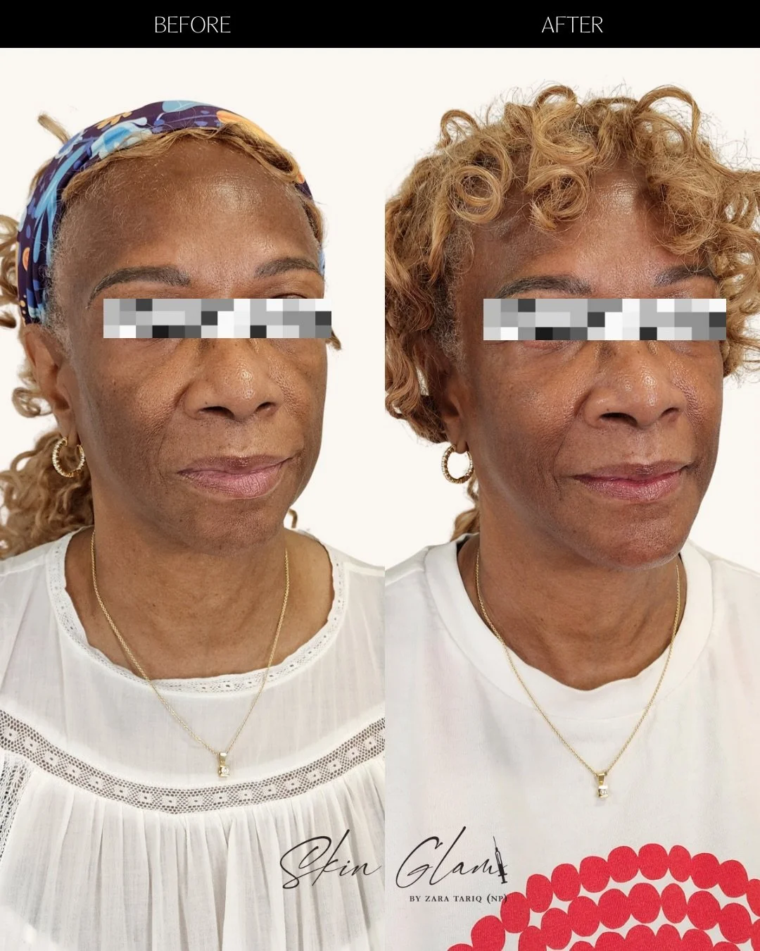 An archive favorite ✨

This is what happens when technique meets restraint.
Every placement intentional. Every detail considered.

The goal was never different.
The goal was refined, rested, and undeniably her 🤍

#houstonaesthetics #luxurybeauty #ho