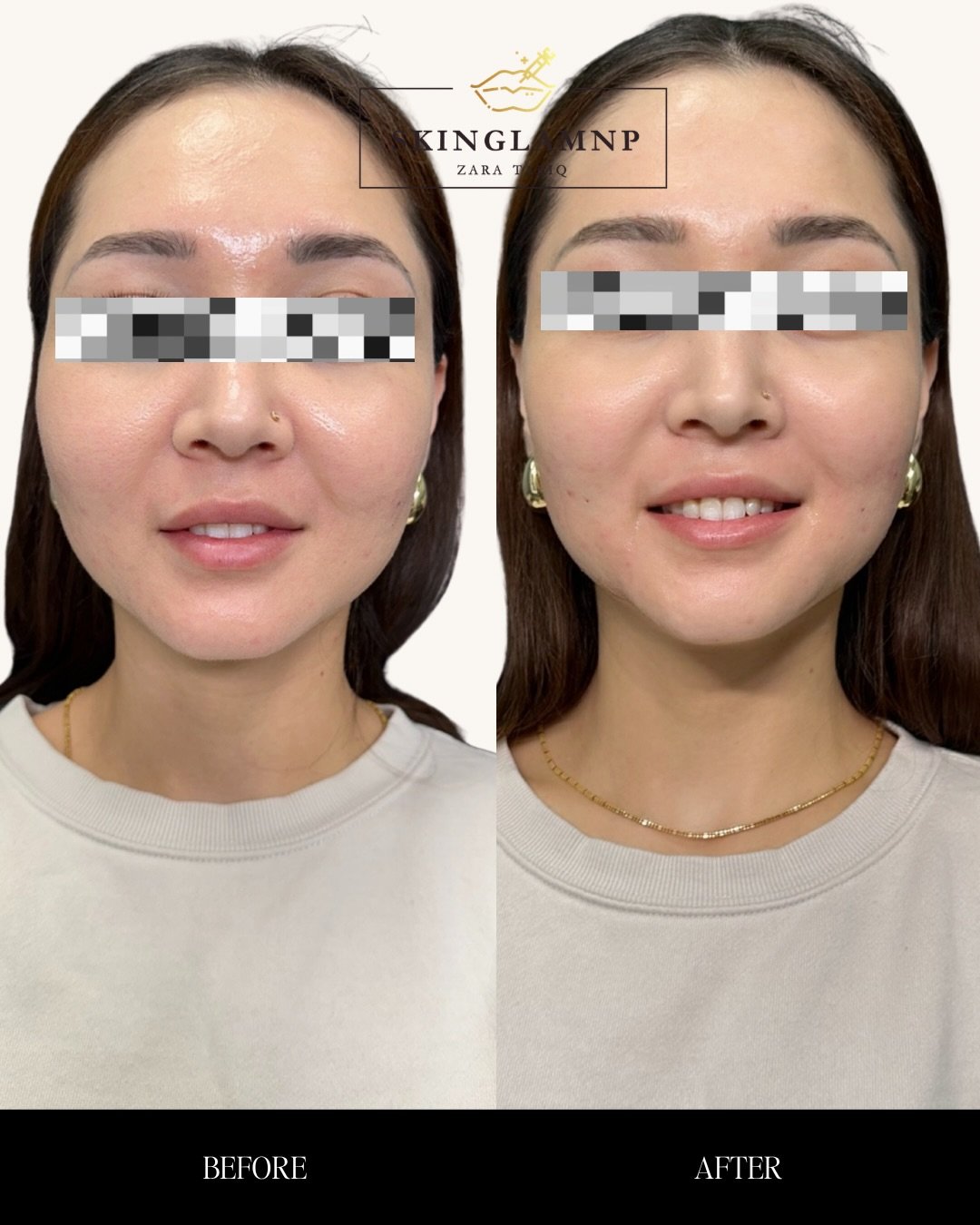 She was already gorgeous ✨ We just added subtle lower face balance and smoothed her smile lines to enhance her natural beauty 💫

Knowing where not to fill is just as important as knowing where to place product. Her cheeks are naturally full and beau