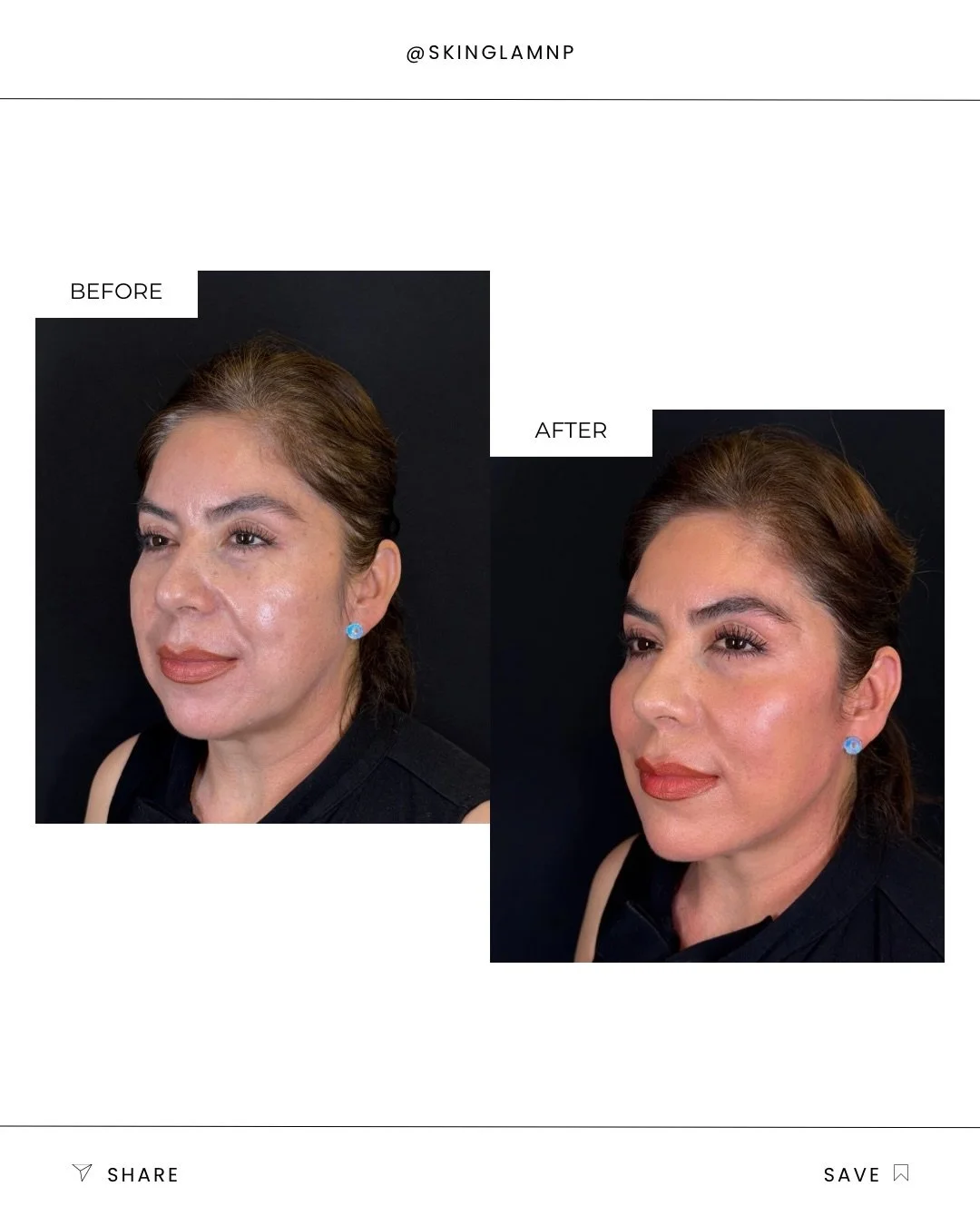 She needed strategic support. 

Full face Radiesse to restore structure, improve skin quality, and bring everything back into balance. 

This is immediately after. 
There is swelling and this will soften down about 20&ndash;30% as it settles. 

The g