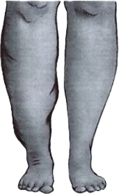 Close-up of a person's legs and feet, with the left leg appearing swollen or enlarged compared to the right leg.