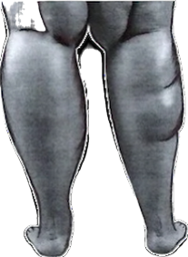 Close-up photo of swollen legs, with visible fluid retention causing lymphedema.