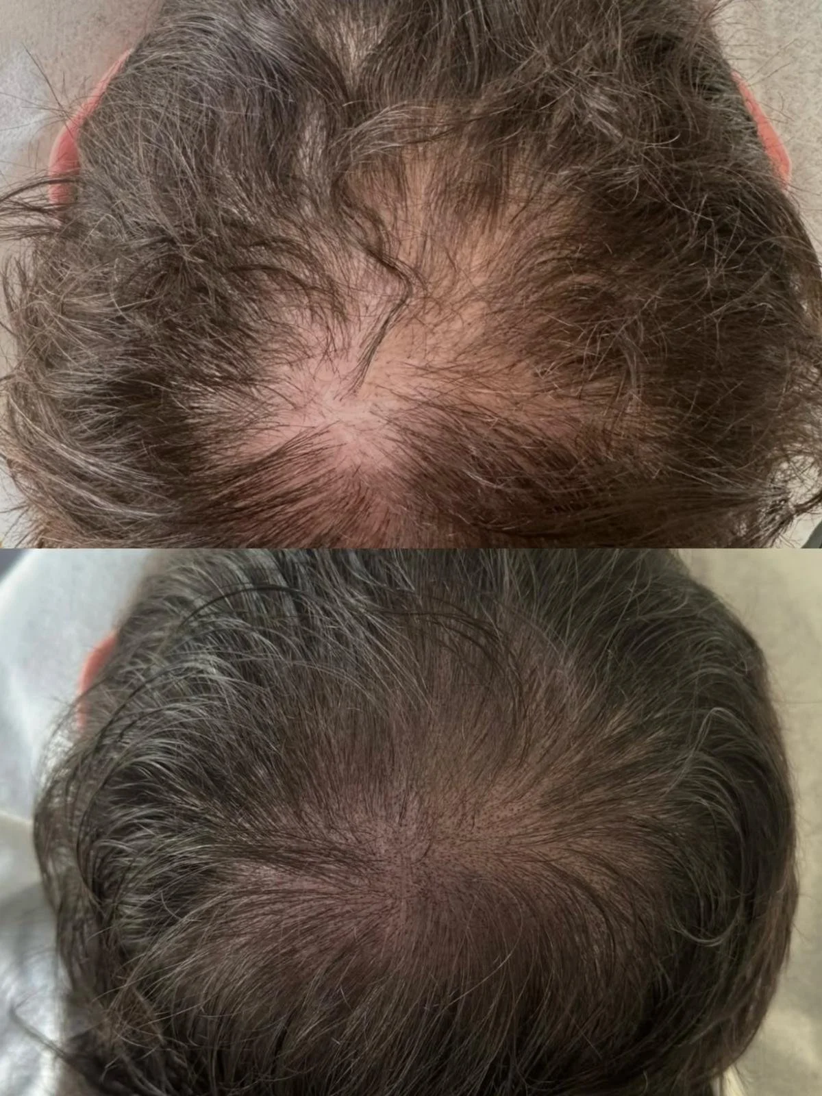Comparison of a person's scalp before and after OKAPP's cosmetic hair restoration treatment, showing increased hair density at the crown.