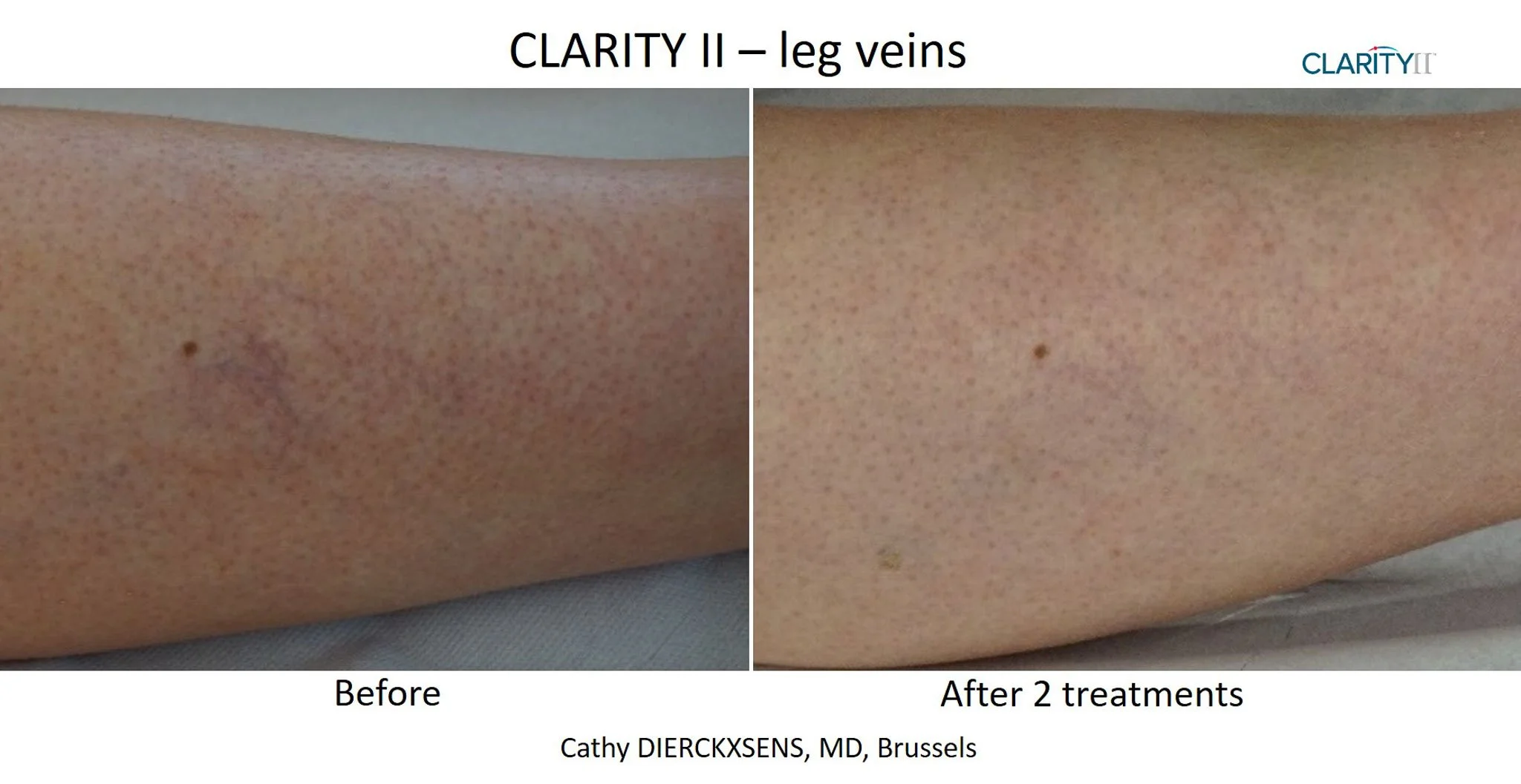 Comparison of leg skin appearance before and after two treatments for leg veins, showing significant reduction in visible veins. The top of the image displays the title 'CLARITY II - leg veins,' with the left side labeled 'Before' showing prominent leg veins, and the right side labeled 'After 2 treatments' showing clearer skin with fewer visible veins. The bottom shows the name Cathy Diercksens, MD, Brussels.