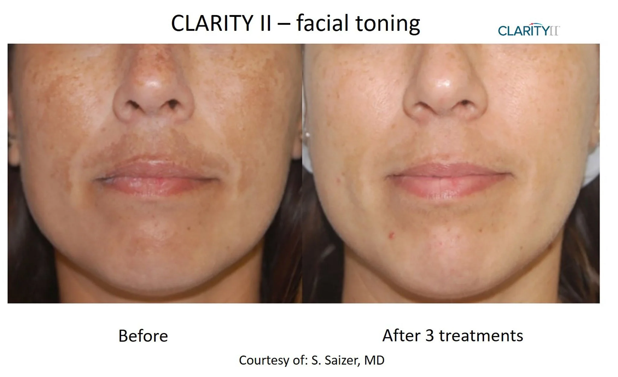 Side-by-side comparison of a woman's face showing skin condition before and after three facial toning treatments, with noticeable reduction in dark spots and even skin tone.
