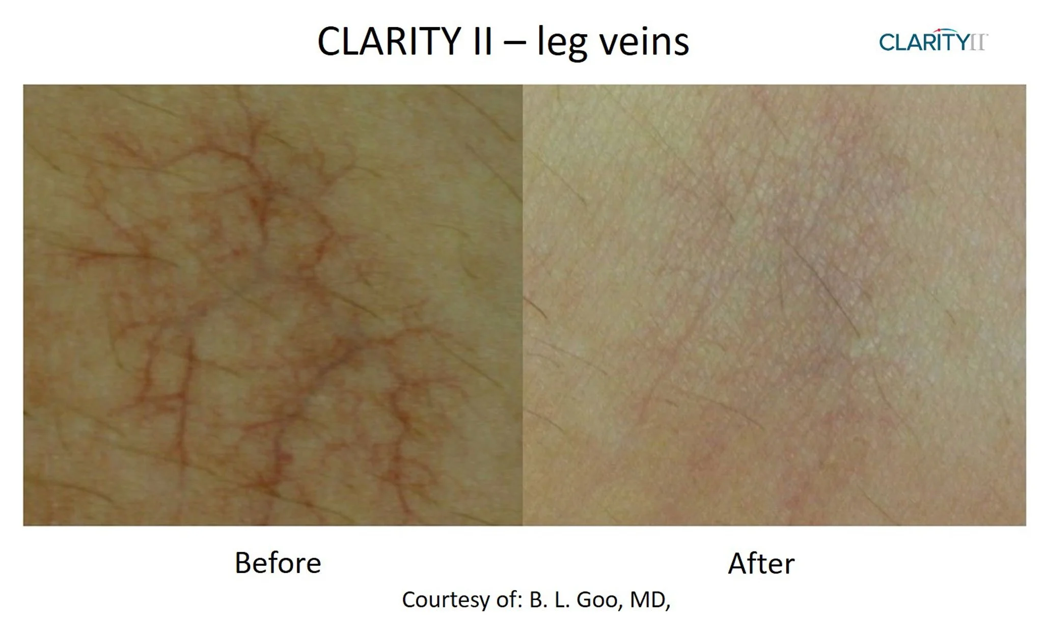 Comparison image showing leg veins before and after a medical procedure, with visible reduction in vein prominence.