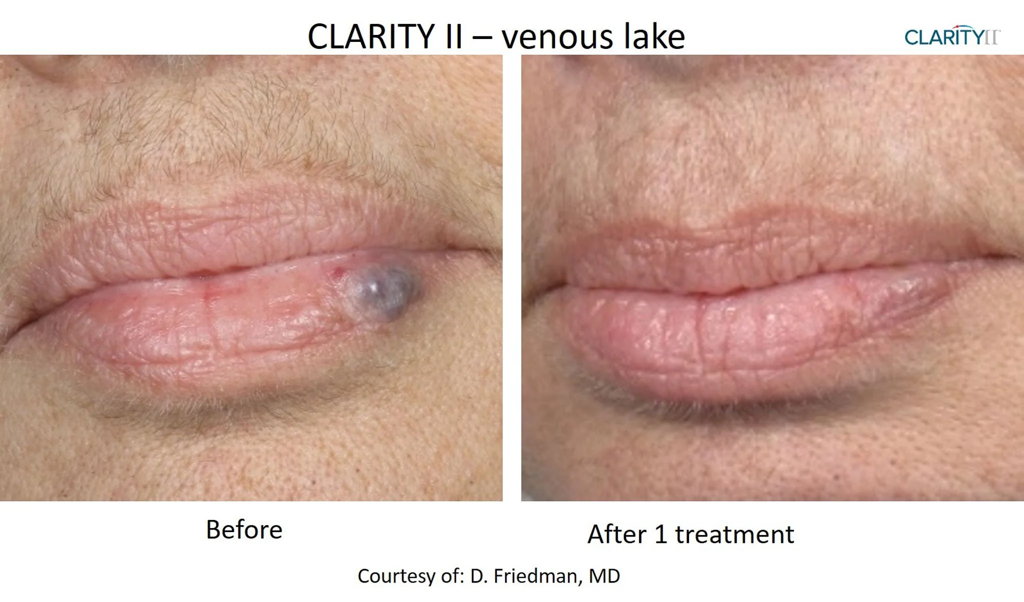 Close-up of a person's lips showing a before-and-after comparison of a venous lake treatment. The left side shows a lips with a dark, bluish lesion, and the right side shows the lips after one treatment with no visible lesion.