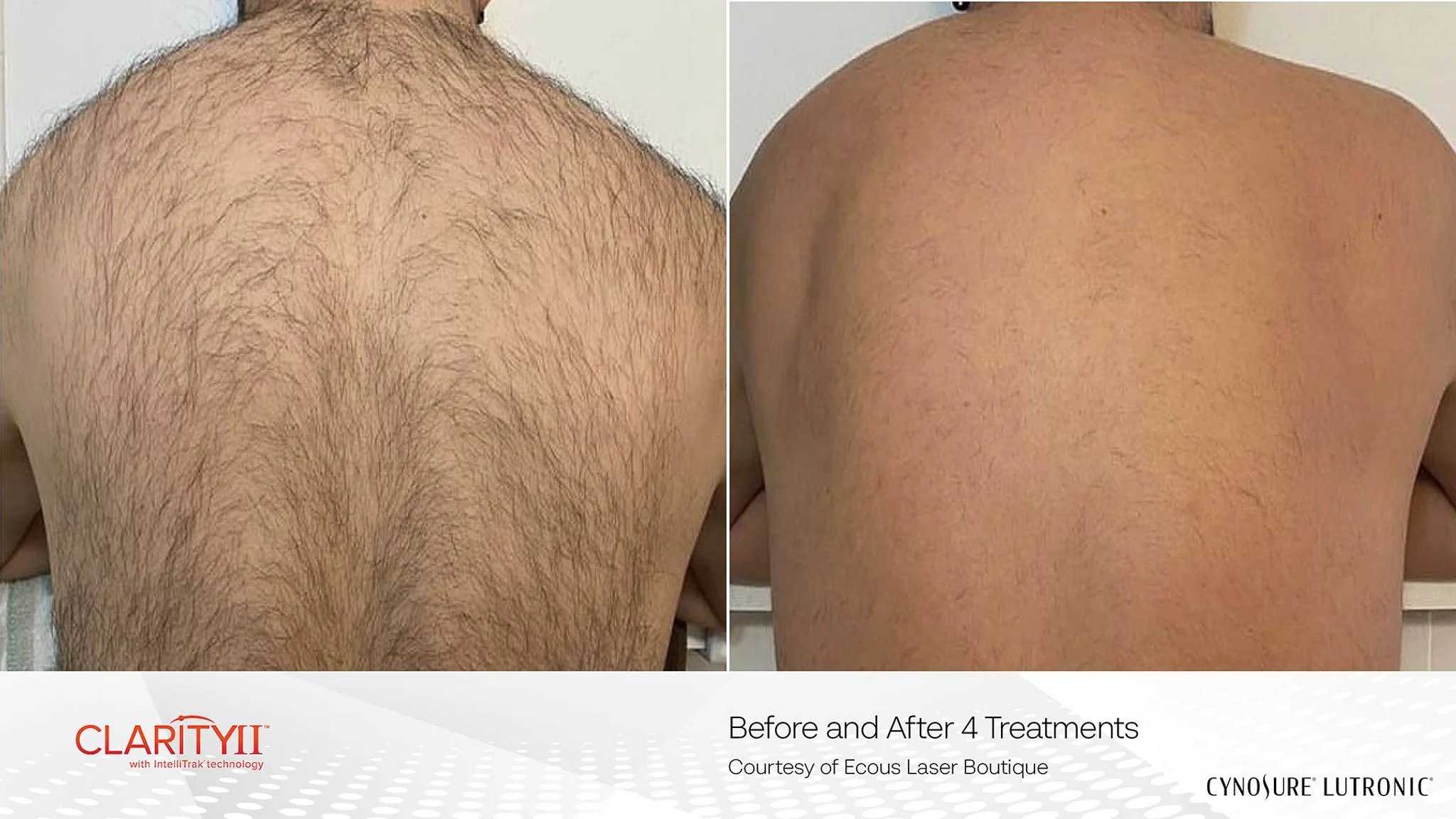 Comparison of a person's back before and after four laser hair removal treatments, showing reduced hair density on the after photo.