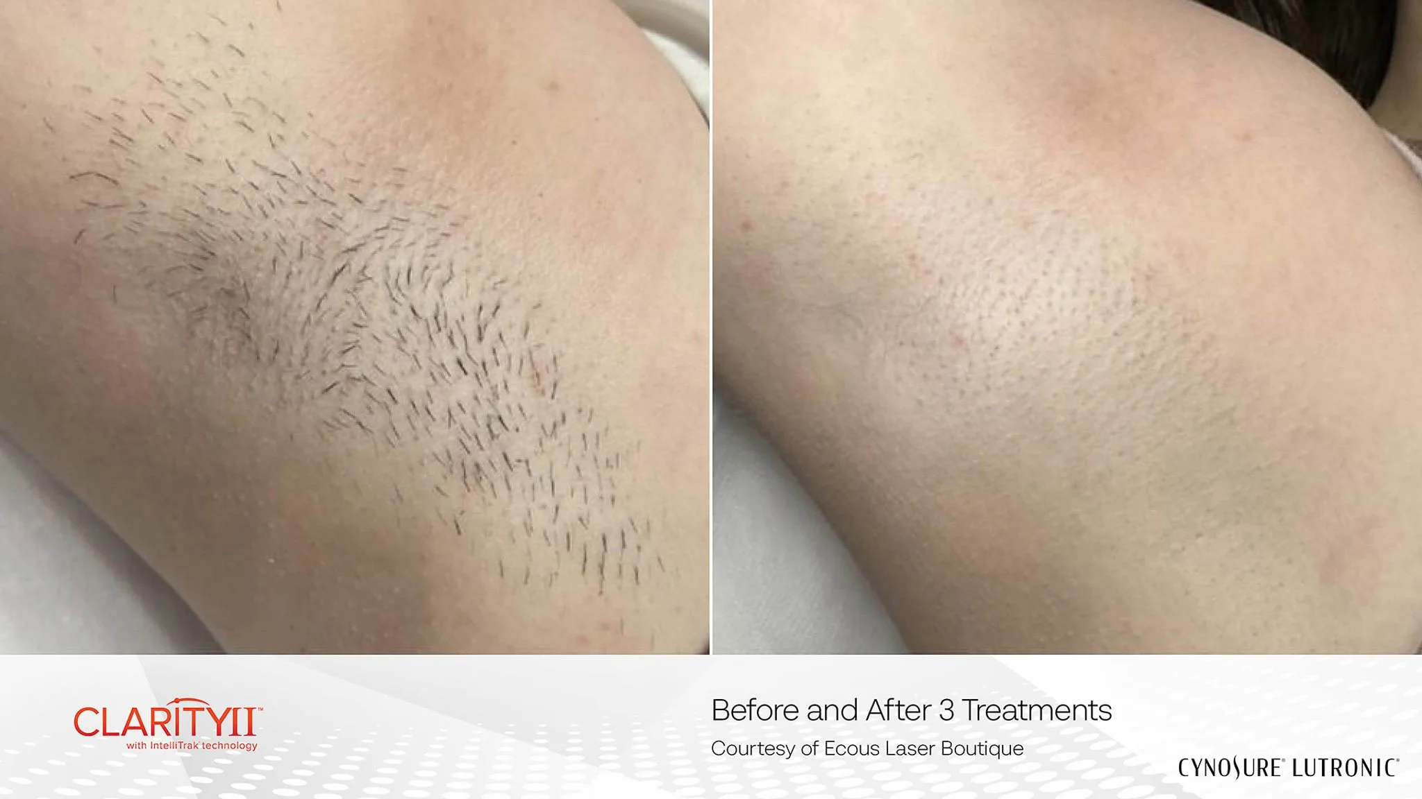 A side-by-side comparison of a person's underarm showing hair removal results before and after three treatments, with the left side showing hairy skin and the right side showing smooth, hair-free skin.