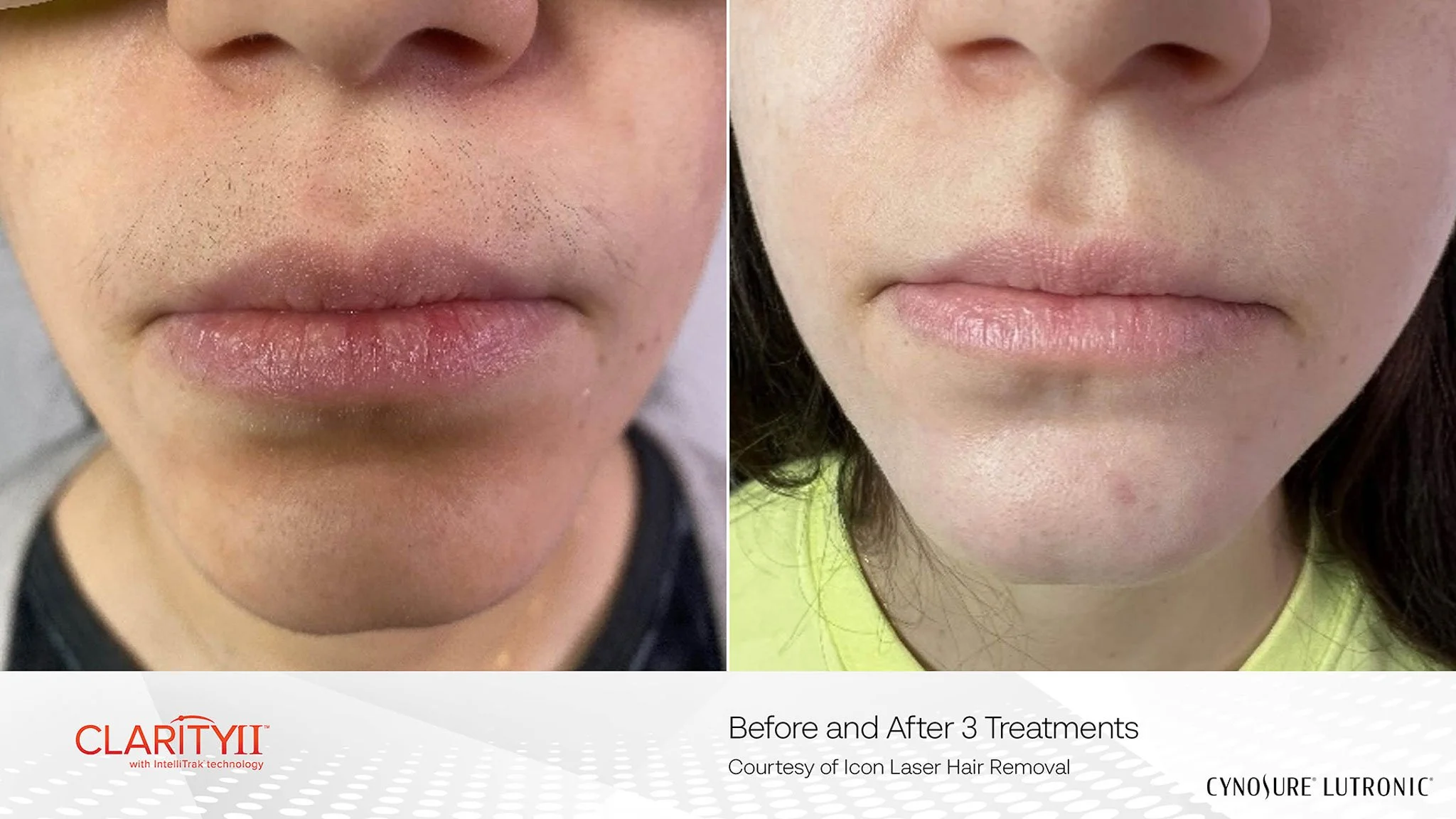 Before and after images showing the removal of facial hair, with the left side displaying facial hair and the right side showing smooth skin after three treatments.