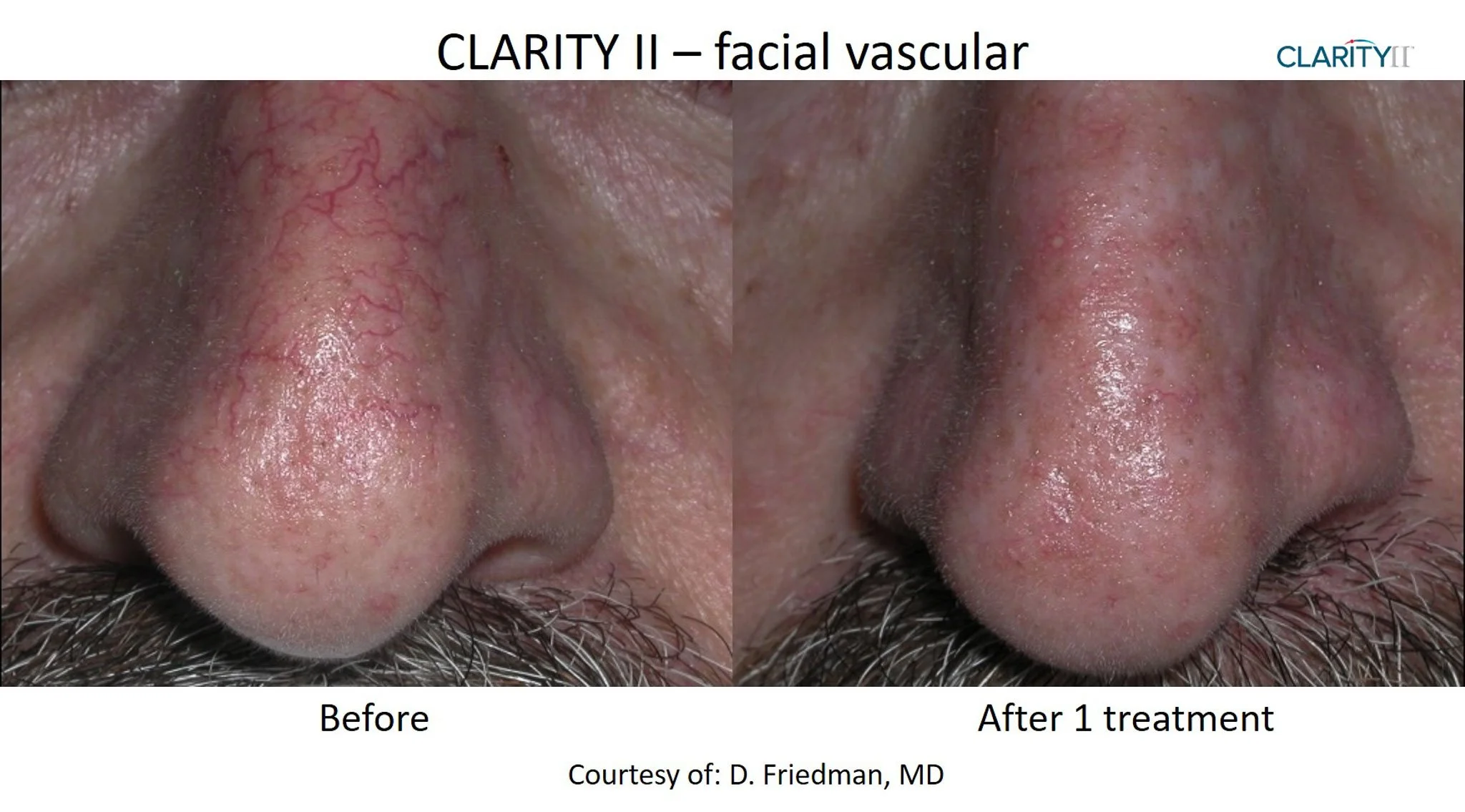 Close-up images of a person's nose, showing visible facial vascularity before and after one treatment. The left image depicts prominent red blood vessels, while the right image shows reduced vascularity and clearer skin.