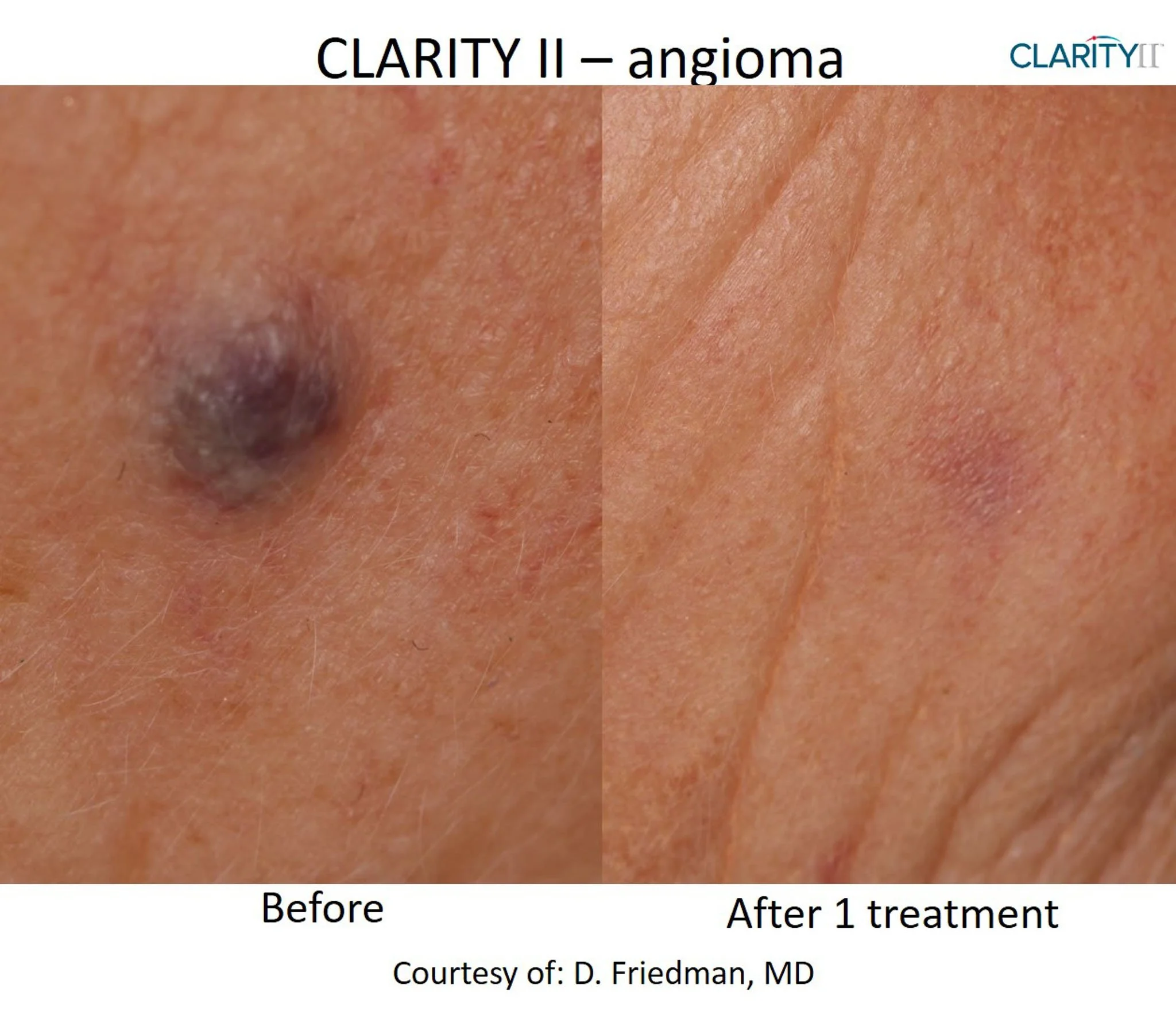 Close-up of skin with dark mole on left, showing improvement after treatment with clearer skin and less discoloration on right.