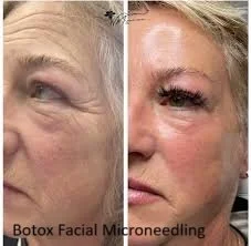 Side-by-side before and after photos showing a woman's face with reduced wrinkles and smoother skin after Botox, microneedling, and facial treatments.