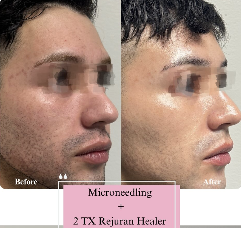 Side-by-side comparison of a man's face before and after microneedling and TX Rejuran healer treatment, showing improved skin texture and reduced acne scars