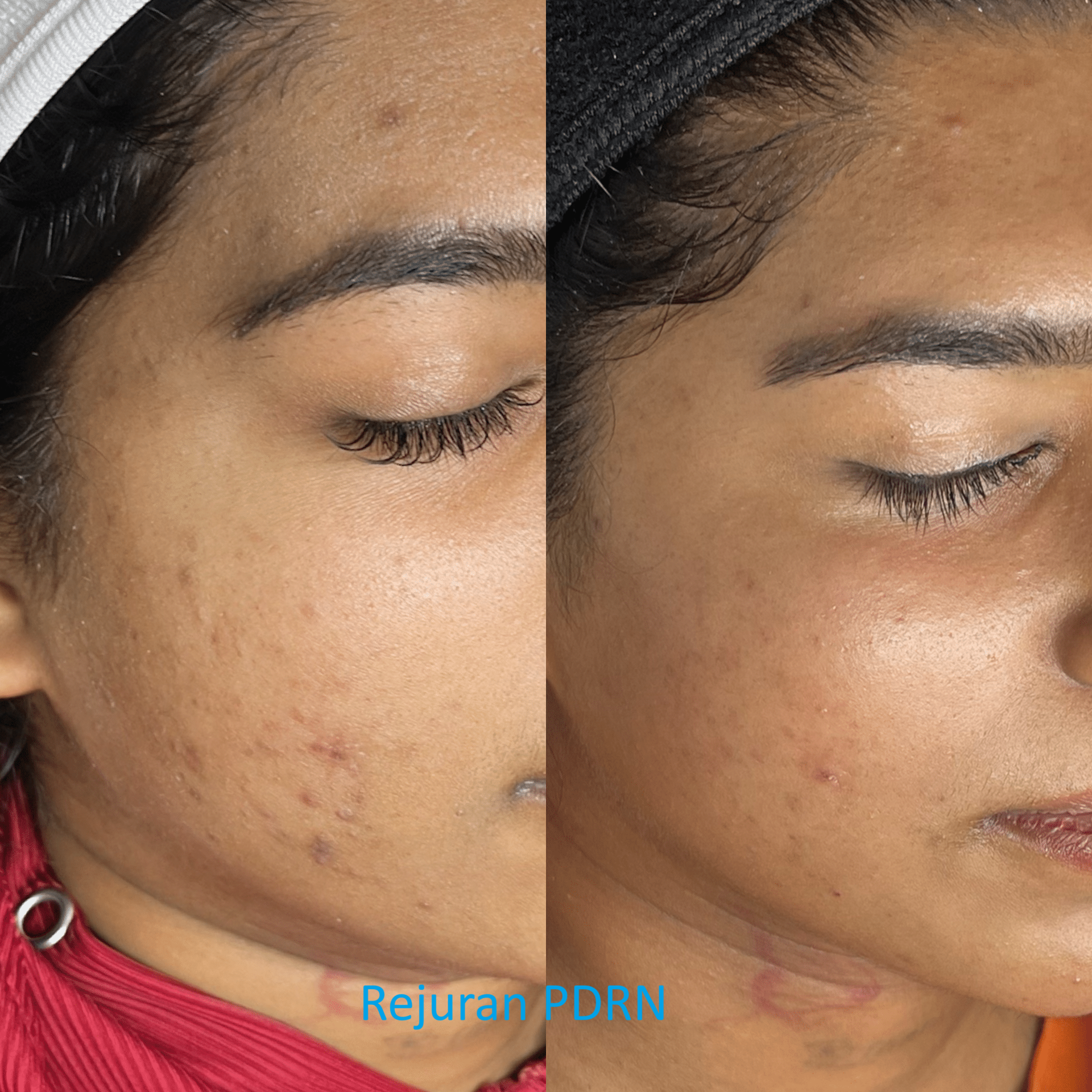Side-by-side comparison of a woman's face showing improved skin condition. The left side shows acne and scars, while the right side shows clearer, smoother skin after treatment.