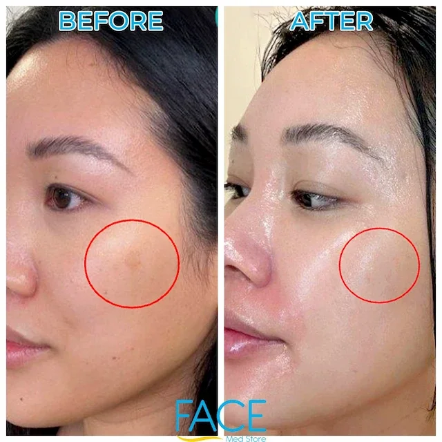 Side-by-side comparison of a woman's face showing a before and after skincare treatment, with the area of concern marked by a red circle.