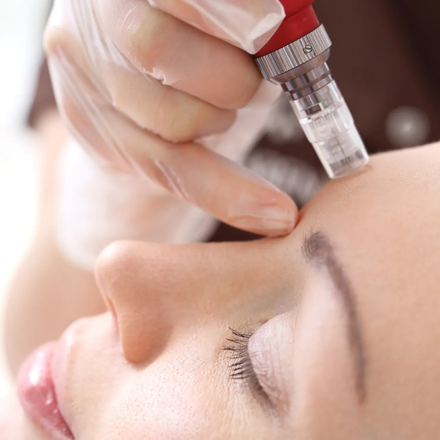A person receiving a cosmetic treatment on their forehead using a pen-like device by a practitioner wearing gloves.
