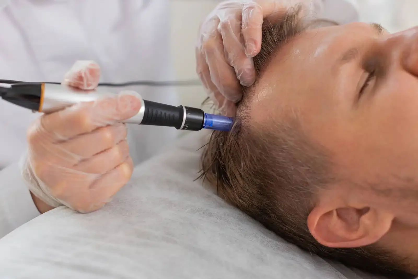 Microneedling pour cuir chevelu, avec un professionnel portant des gants en intervention.