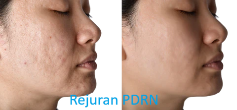 Side comparison photo of a woman's face showing skin improvement, with clearer skin on the right side after treatment.