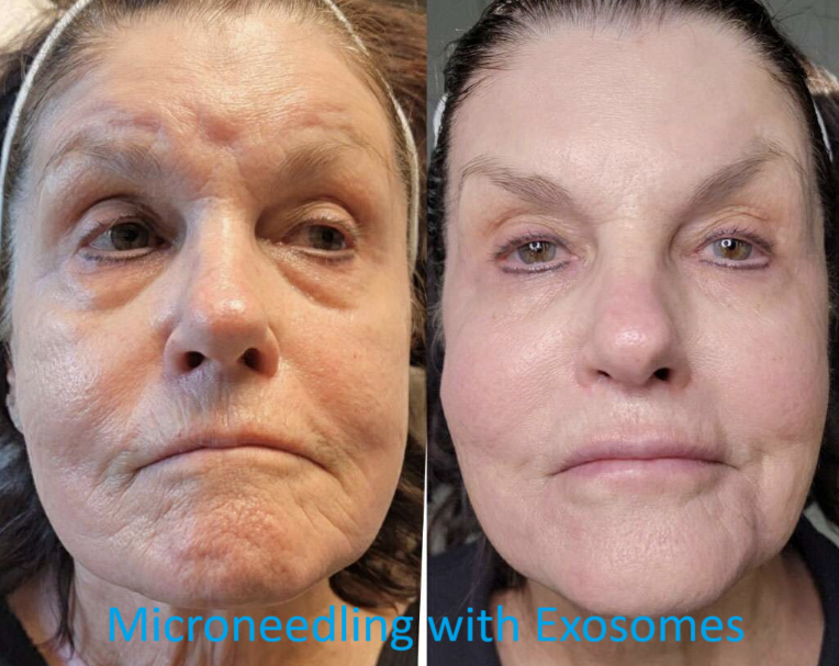 Side-by-side images of a woman before and after microneedling with exosomes, showing improved skin texture and reduced wrinkles.