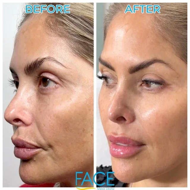 Side-by-side comparison photo of a woman's face labeled 'Before' and 'After', showing improvements in skin clarity, texture, and lip fullness after skincare or cosmetic treatment.