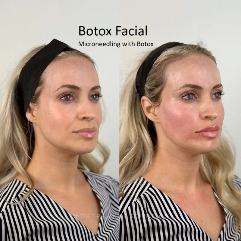 Before and after comparison of a woman receiving Botox facial treatment, showcasing microneedling with Botox for facial aesthetics.