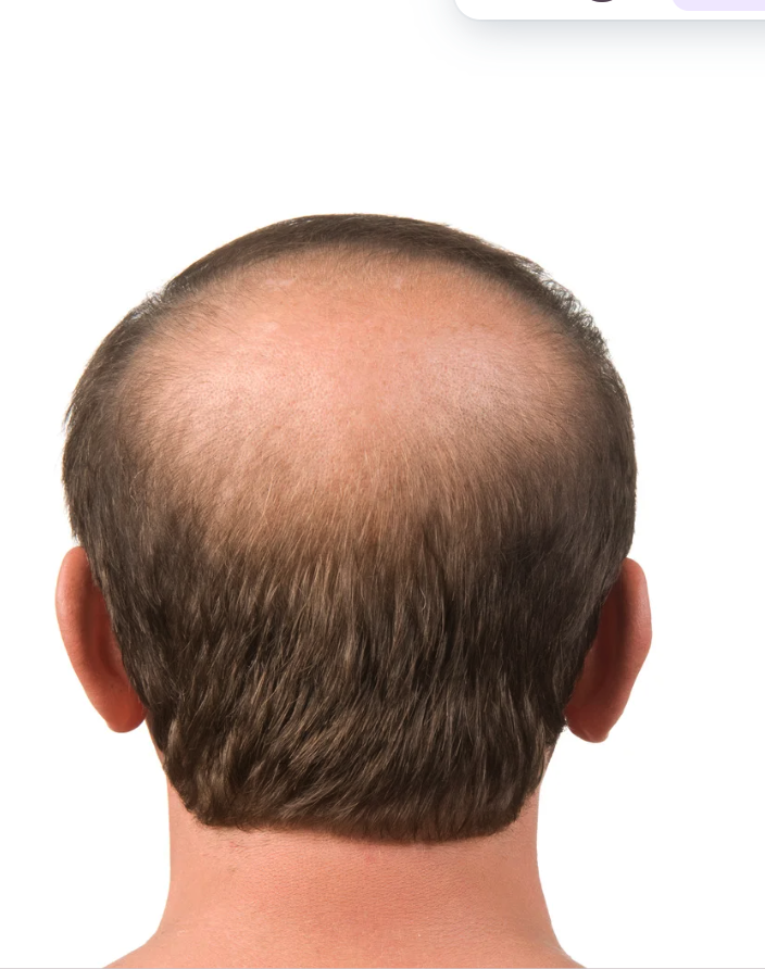 Back view of a bald man with a receding hairline and thinning hair on the crown, with short brown hair on the sides and ears visible.