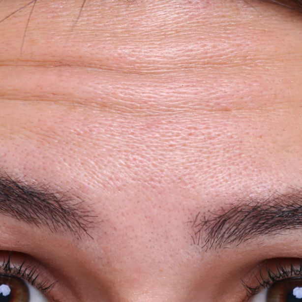 Close-up of a person's forehead and eyebrows showing visible pores and skin texture.