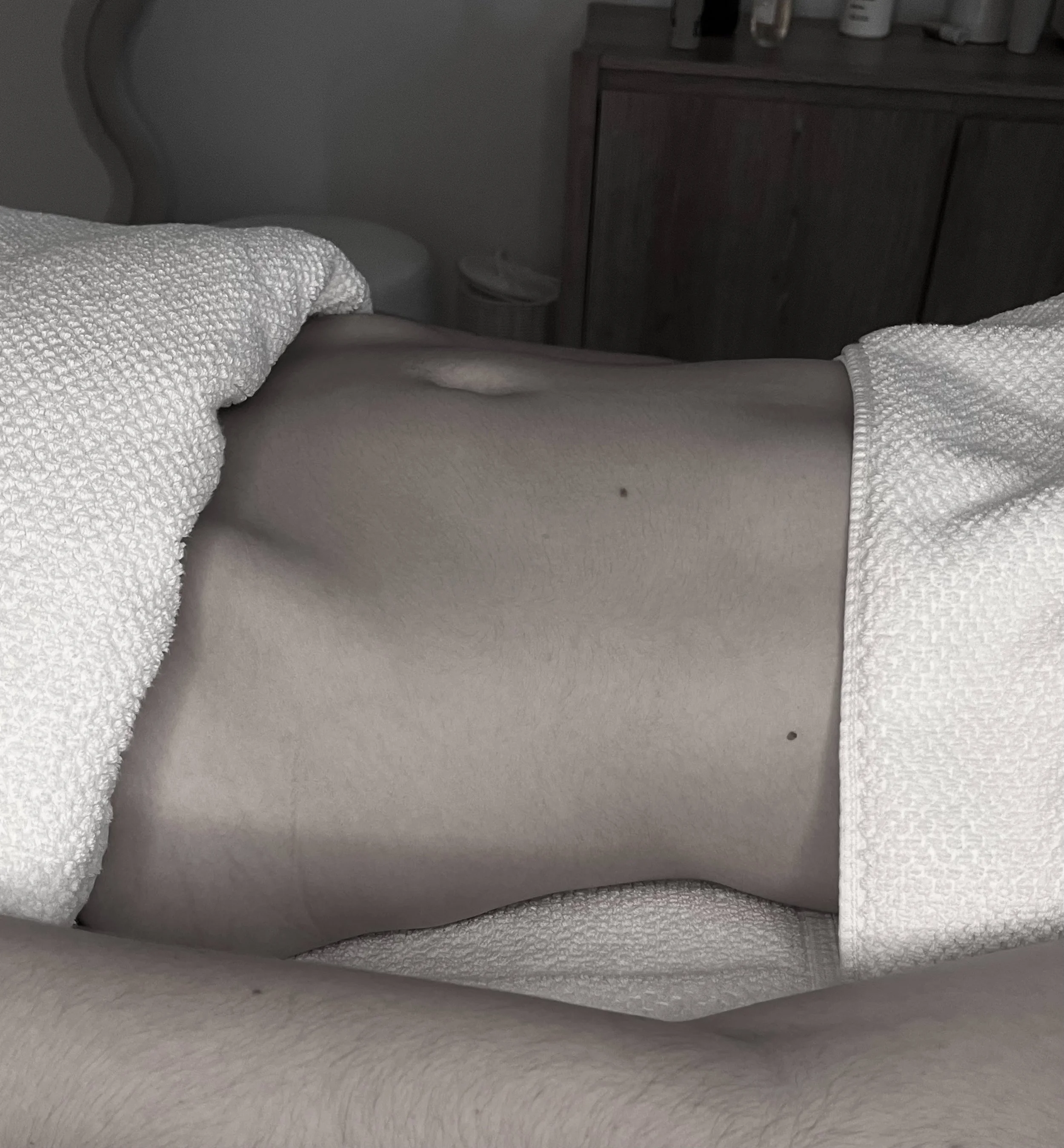 Close-up of a person's bare stomach with small moles, partially covered by a textured white towel or blanket, in a clinical or spa setting.