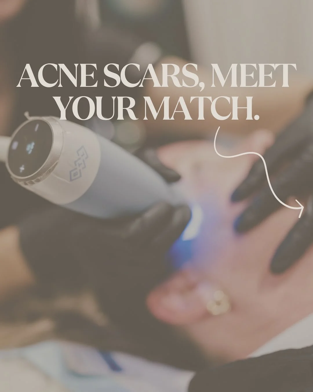 Fractional treatments are a game changer when it comes to smoothing texture and fading acne scarring. These results speak for themselves &mdash; swipe to see results! 

If acne scars have been holding you back, book your free consultation and let&rsq